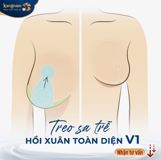 Treo ngực sa trễ tạo hình lại vòng 1 cân đối