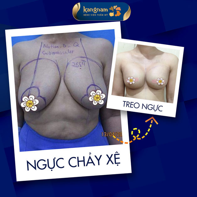 Treo sa trễ ngực chảy xệ, lấy lại vòng 1 săn chắc, cân đối