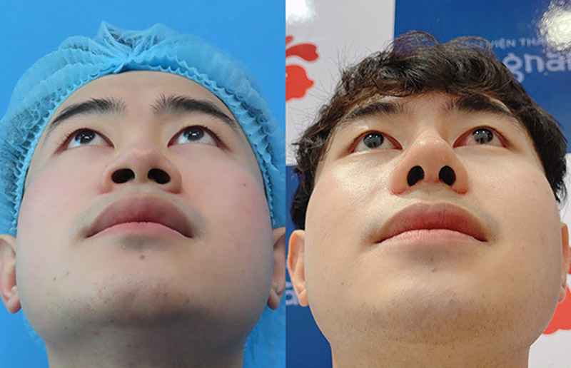 Mũi thon gọn giúp gương mặt sắc cạnh hơn