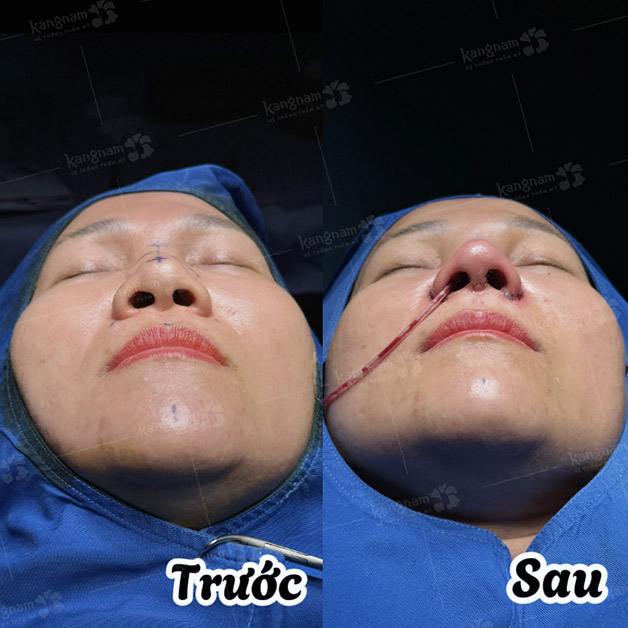Trước và sau khi thực hiện nâng mũi Pureform tại Kangnam