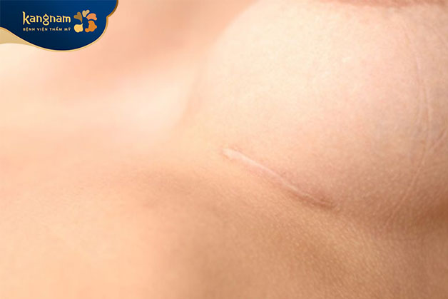 Khi thực hiện đường mổ ở chân ngực, vết mổ nằm ở nếp gấp dưới vú, sẹo mờ và ít nhìn thấy