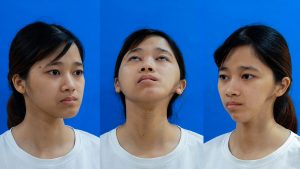 Trở về sau phẫu thuật thẩm mỹ, cô gái mặt lõm Ninh Thị Thu Hường khiến cả họ ngỡ ngàng