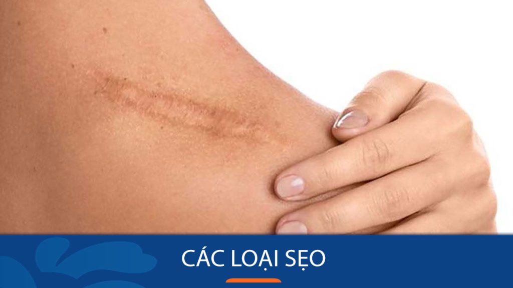 Giải mã các loại sẹo thường gặp: Bí quyết nhận biết và cách điều trị hiệu quả