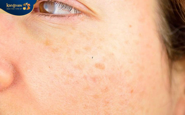 Đốm nâu xuất hiện trên gò má do sự tích tụ melanin trong da