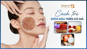 6 Cách trị đốm nâu trên gò má đơn giản,Bác sĩ da liễu chia sẽ