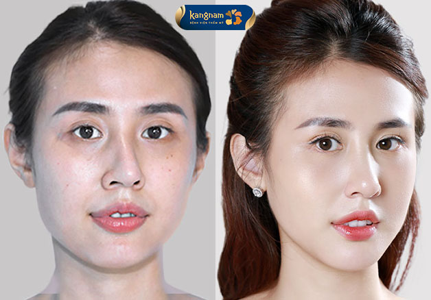 Trường hợp chỉnh sửa mũi lệch vẹo thành công của Dr.Henry Nguyễn trong "Beauty Up"
