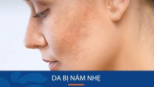 Tình trạng da bị nám nhẹ do đâu? Bác sĩ da liễu trả lời