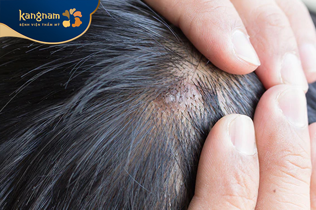 Da đầu bị nổi mụn thường là dấu hiệu viêm nang lông, dị ứng, mụn trứng cá