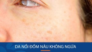 Da nổi đốm nâu không ngứa do đâu? Bác sĩ da liễu trả lời