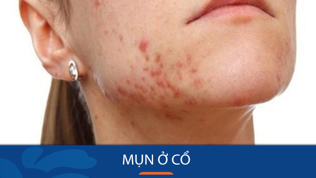 Mụn ở cổ: Nguyên nhân, cách điều trị và phòng ngừa