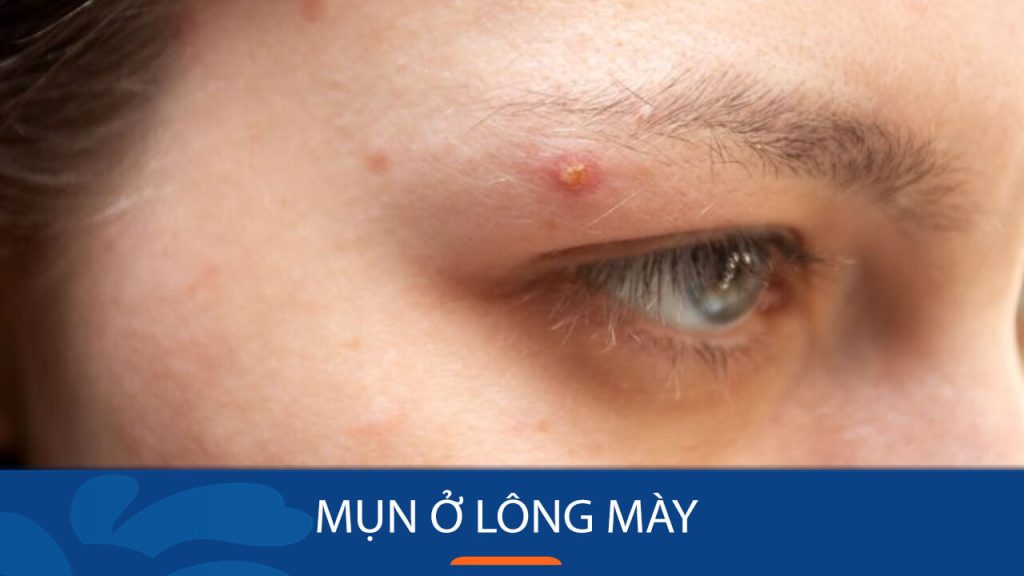 Mụn ở lông mày: Nguyên nhân, cách điều trị và phòng ngừa