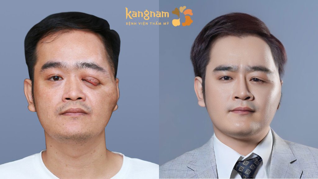 Hành trình lột xác ngoạn mục của chàng trai dị dạng một mắt – Nguyễn Thanh Hưng