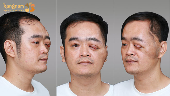 Nguyễn Thanh Hưng gặp tình trạng u xơ thần kinh, mắt trái không còn thị lực