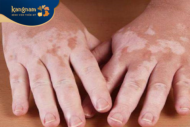Một số trường hợp thay đổi sắc tố da do bệnh lý tiềm ẩn