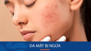 Da mặt bị ngứa: Triệu chứng, nguyên nhân và cách điều trị