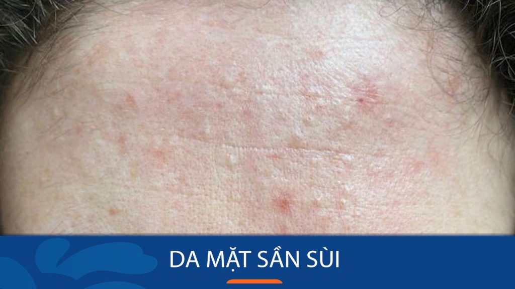 Da mặt sần sùi: Dấu hiệu, nguyên nhân và phương pháp cải thiện