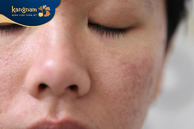 Bệnh về da như chàm, vảy nến, viêm da tiếp xúc,... cũng có thể gây ngứa da mặt