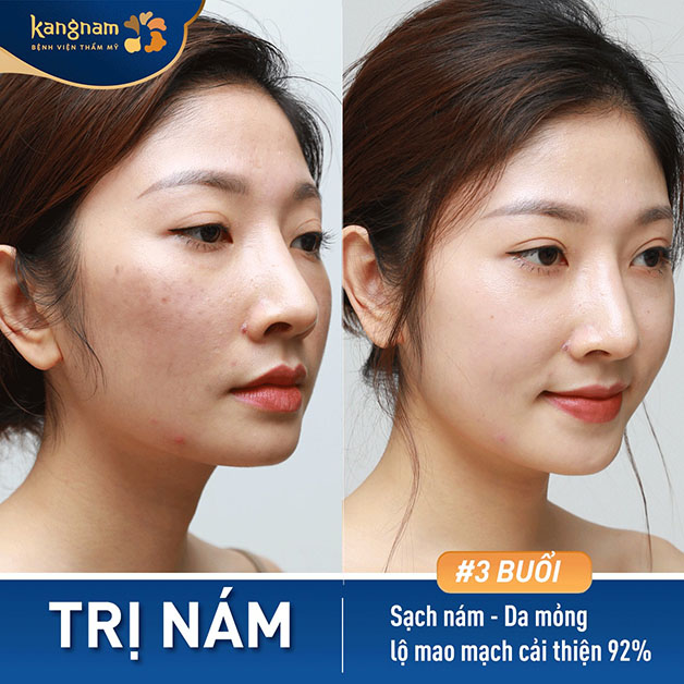 Làn da sáng khỏe và mịn màng sau khi điều trị tại Kangnam