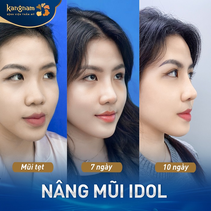 Công nghệ nâng mũi IDol, thiết kế dáng mũi độc bản