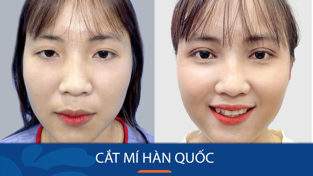 Cắt mí Hàn Quốc là gì? tiêu chí Nhẹ Nhàng, Không Đau, Đẹp Chuẩn Sao