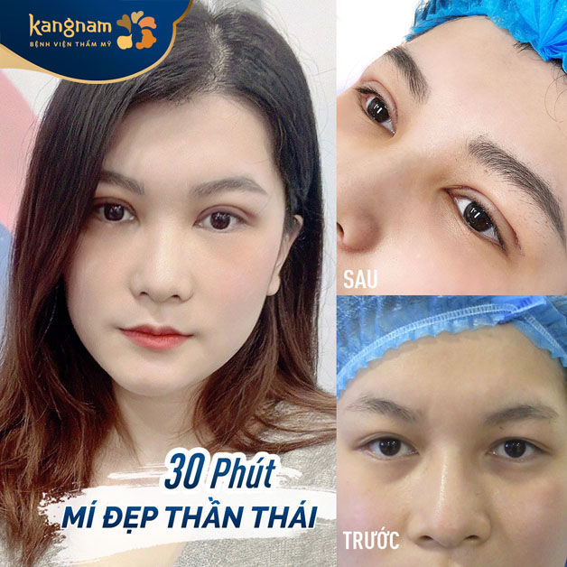 Chỉ sau 30 phút, hoàn thành xong ca cắt mí cho chị khách xinh đẹp