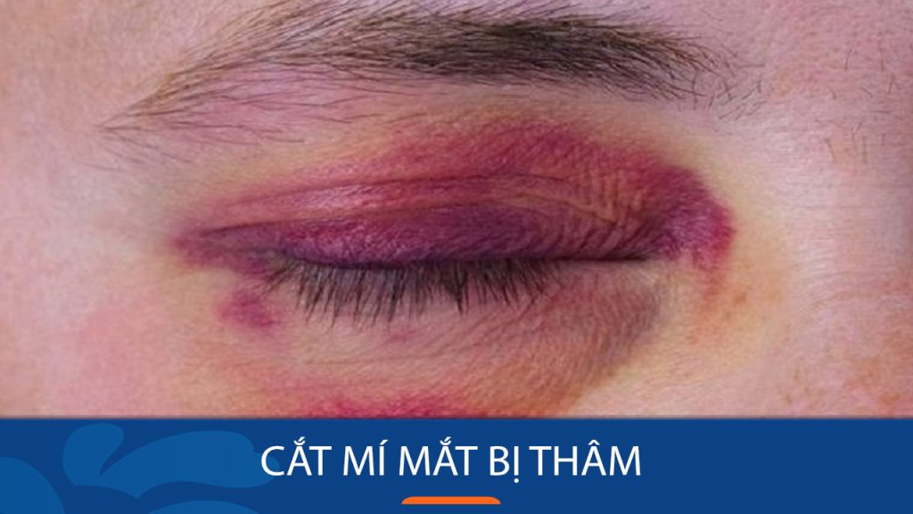 Cắt Mí Mắt Bị Thâm: Giải Mã Nguyên Nhân và Cách Xử Lý Hiệu Quả Nhất