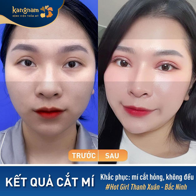 Khắc phục hoàn toàn tình trạng cắt mí mắt hỏng, không đều