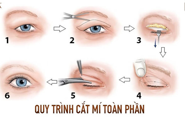 Cắt mí mắt Hàn Quốc toàn phần là phương pháp tiểu phẫu loại bỏ da chùng, mỡ thừa cho toàn bộ phần mí mắt