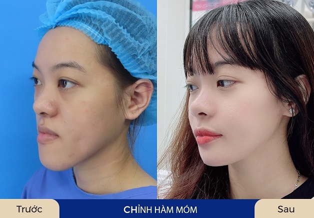 Khách hàng sở hữu khuôn mặt cân đối sau chỉnh hàm