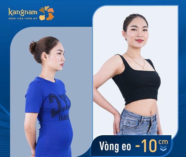 Hút mỡ bụng cần kiêng khem đúng cách để cơ thể nhanh phục hồi và duy trì vòng eo thon gọn