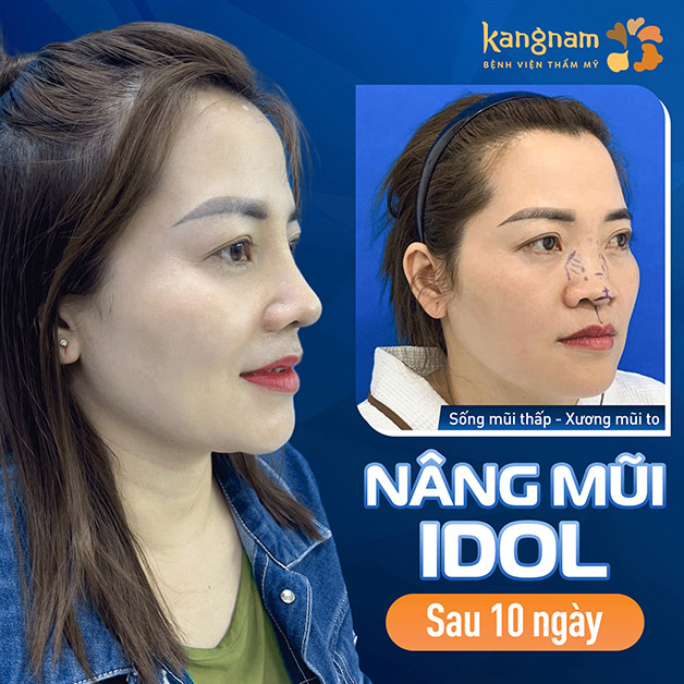 Nâng mũi Idol sau 10 ngày, mũi cao mềm mại, chuẩn tỷ lệ vàng với gương mặt