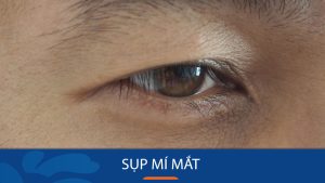 Sụp mí mắt : nguyên nhân và phương pháp điều trị hiệu quả tại Hà Nội uy tín