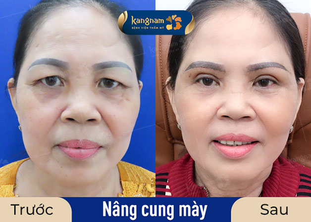 Nâng cung mày giúp khắc phục sụp mí