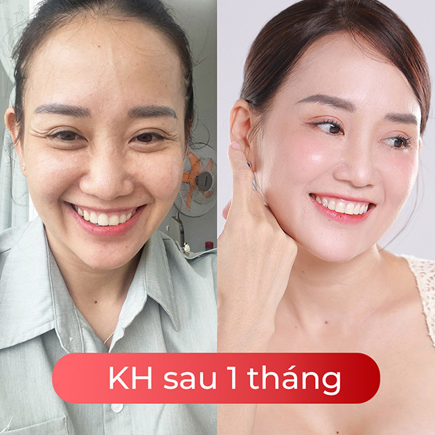 Trẻ hóa gương mặt toàn diện, hết nhăn, gương mặt tươi trẻ