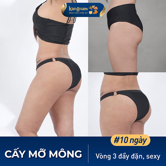 Cấy mỡ nâng mông an toàn, nhanh hồi phục