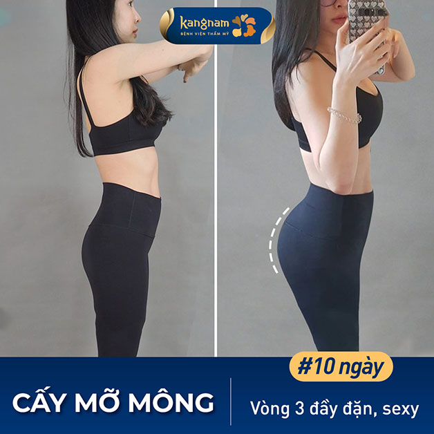 Có ngay dáng chữ S sau khi cấy mỡ mông