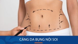 Căng da bụng nội soi – con đường ngắn nhất để có vòng eo săn chắc