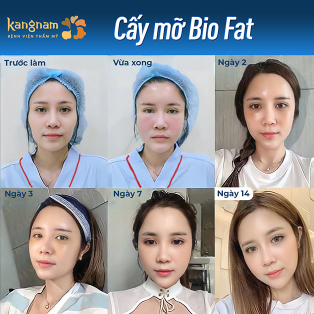 Cấy mỡ mặt Bio Fat an toàn, nhanh hồi phục