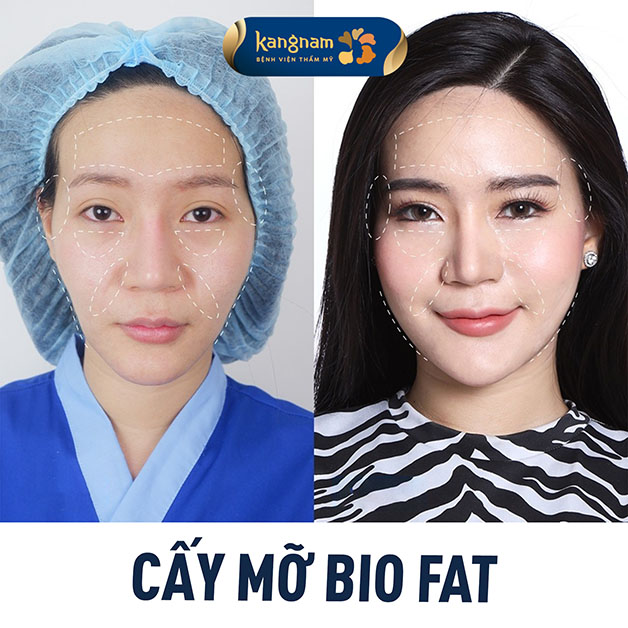 Chỉ 60 phút thực hiện khắc phục hoàn toàn tình trạng mặt hốc hác, già nua