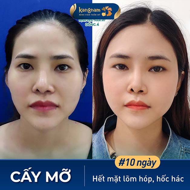 Gương mặt hết lõm hóp, hốc hác