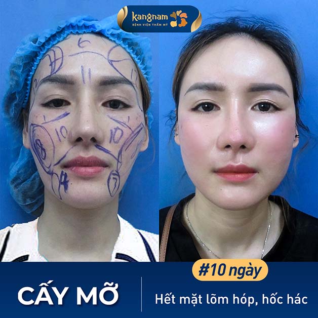 Tỷ lệ gương mặt hài hòa, cân đối chuẩn mặt trái xoan