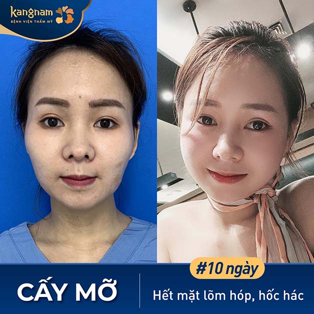 Cấy mỡ mặt giúp má đầy đặn, gương mặt cân đối hơn