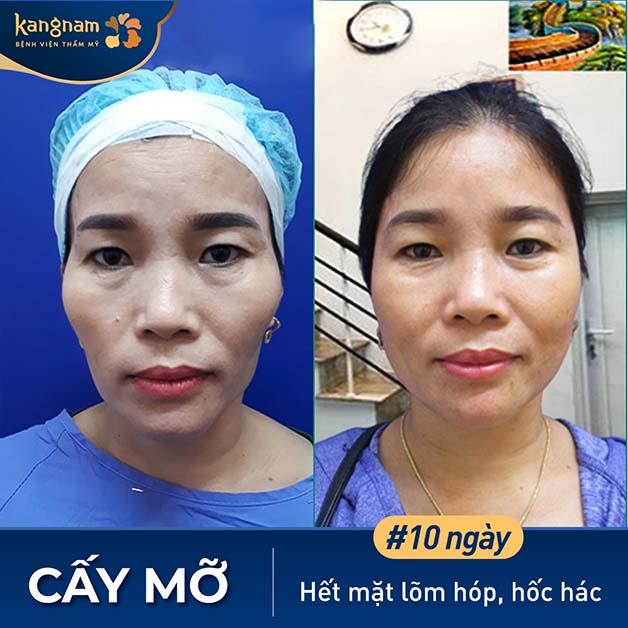 Gương mặt đầy đặn, trẻ trung, hết hốc hác và nếp nhăn