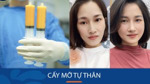 Cấy mỡ – Làm đẹp bằng mỡ tự thân