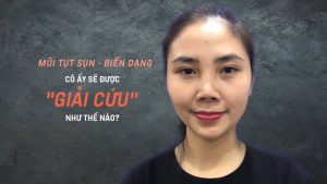 Sửa mũi hỏng, tụt sụn do tai nạn