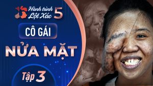 Hành Trình Lột Xác mùa 5 | Tập 3: Phạm Thị Diệu Thúy – Cô gái nửa khuôn mặt