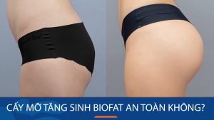 Cấy mỡ tăng sinh BioFat cho mông lép có an toàn không?