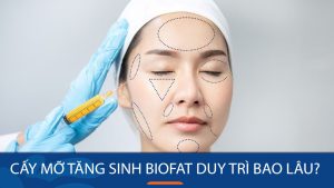 Cấy mỡ tăng sinh BioFat duy trì được bao lâu? Vĩnh viễn hay tạm thời