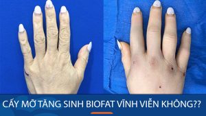 Cấy mỡ tăng sinh BioFat có được vĩnh viễn không?