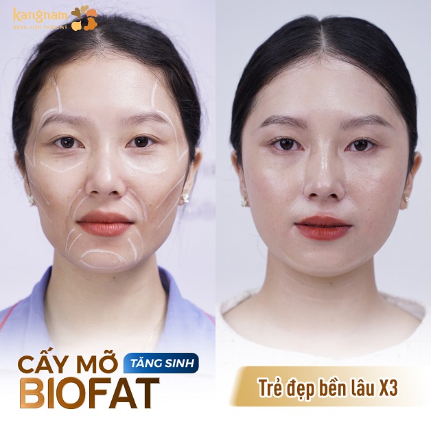 Cấy mỡ Biofat tăng sinh kết hợp với tế bào gốc mang lại hiệu quả lâu dài